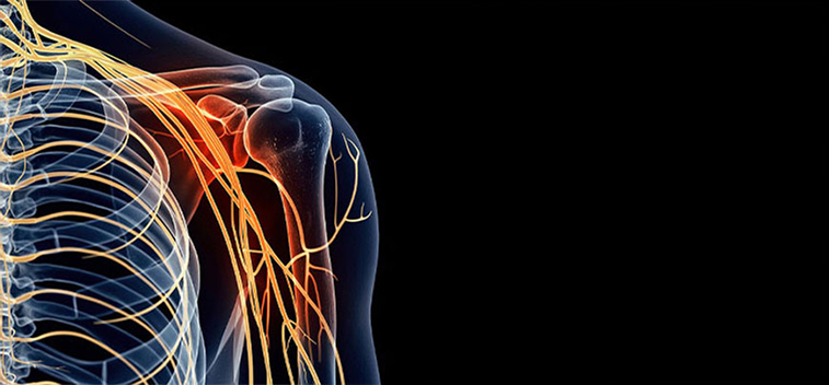 Patient experiencing Brachial Plexus Neuropathy and in need of the neuropathy treatment protocol at Peninsula RSI Chiropractic Wellness Center in Redwood City